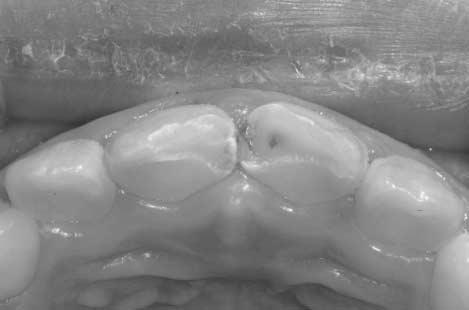 upper central incisors in a