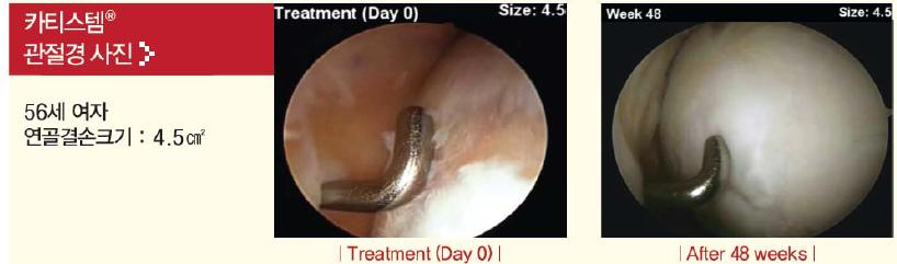 동사의퇴행성관절염줄기세포치료제인카티스템은연골재생에뛰어난효과를보이고있다.
