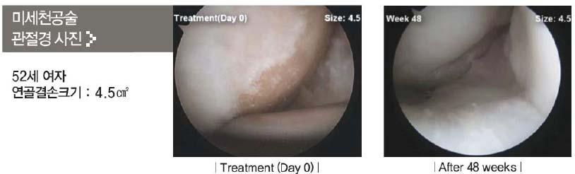정상연골과유사한유리질의튼튼한연골이재생됨을확인하였다.