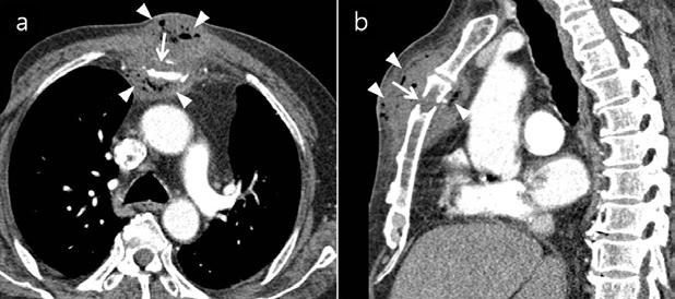 포스터발표 B-13 Sternal Osteomyelitis with Mediastinal Abscess Caused by Gemella Morbillorum after Blunt Force Trauma 권재철 ¹, 안진영 ², 송제은 ², 김민형 ², 오동현 ², 박윤선 ¹, 김아영 ³, 강두영 ⁴ 1 국민건강보험공단일산병원내과, 2