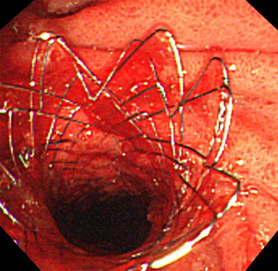 The jejunal specimen after jejunal segmental resection showed marked fibrosis, necrosis, and chronic inflammation without residual cancer (H&E