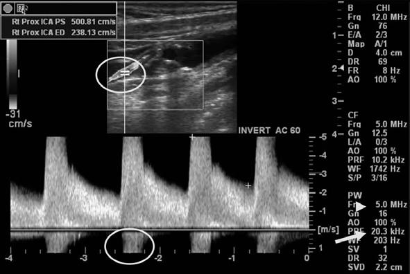 Fig. 14. Aliasing artifacts(round circles) in pulsed Doppler spectral display and color-doppler of duplex ultrasonography in the stenosed internal carotid artery.