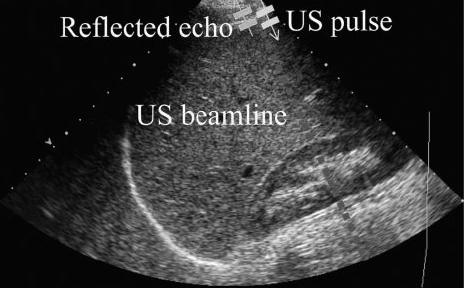Fig. 4. Sequence of pulse-echo technique diagrams show the propagation of an ultrasound pulse(yellow descending arrow) along on particular beam line(dotted line).