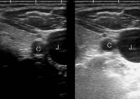 B-mode transverse images of common carotid artery(c) and jugular vein(j) show less compensated by time(left) and compensated image(right).