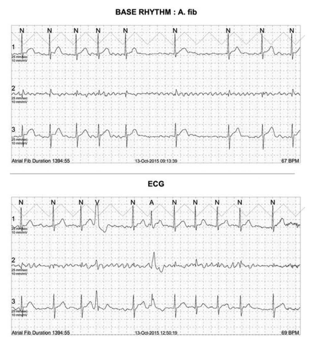 8 24 시간심전도검사 (Holter Monitoring) 1 소개및목적