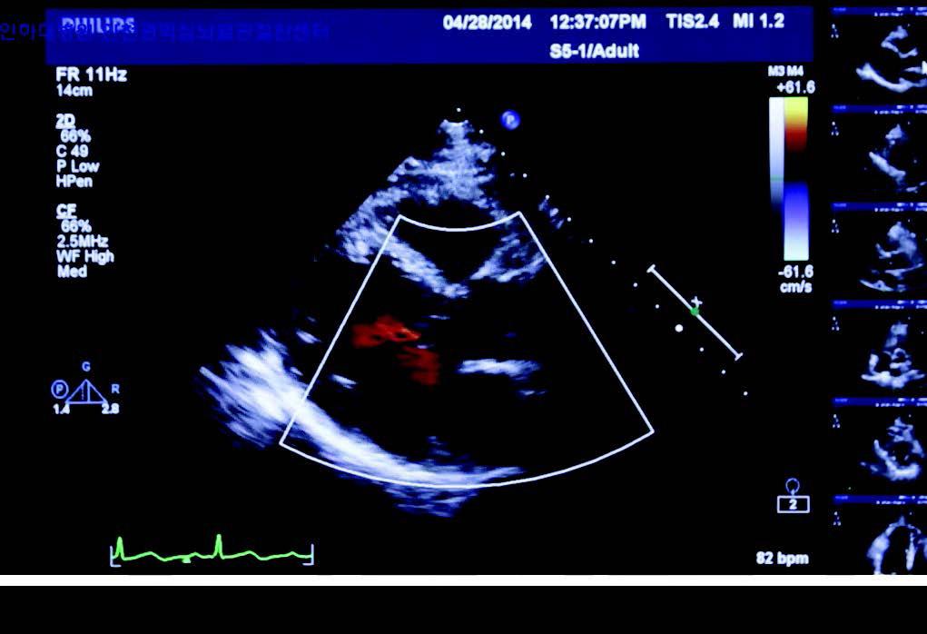 9 심초음파검사 (TTE : Transthoracic Echocardiography) 1 소개및목적 초음파를이용하여심장내부구조,