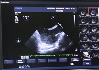 10 경식도심초음파검사 (TEE : Transesophageal Echocardiography) 1 소개및목적 초음파탐촉관을내시경처럼식도에삽입하여시행하는검사 ( 일반심초음파보다심장과더가까운위치에서검사하므로,