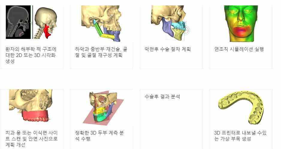 시술에대한계획을세워수술결과를개선하는것이주목적이며 환자의 영상이미지 를이용하여아래와같이작업을할수있음 엉덩이관절시술을받은경우통계적으로 정도가재수술을요하며 조사에따르면재수술의실패율은 의경우로증가 재수술은위치 움직임 감염등의이유로많이발생하는데 재수술을계 속하는경우골손실의정도가커지는경우가일반적임 년의시간동안 모델링은통한제품서비스활동은임플란트이식 성공률은