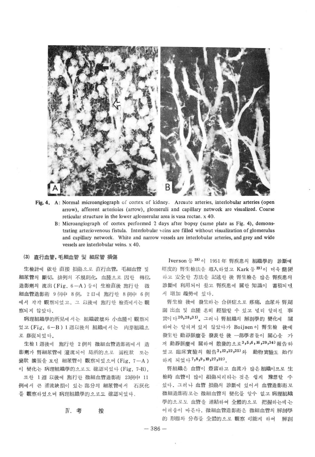 Fig.4. A: Normal microangiograph of cortex of kidney. Arcuate arteries, interlobular arteries (open arrow), afferent arterioìes (arrow), glo meruli and capillary network are visualized.