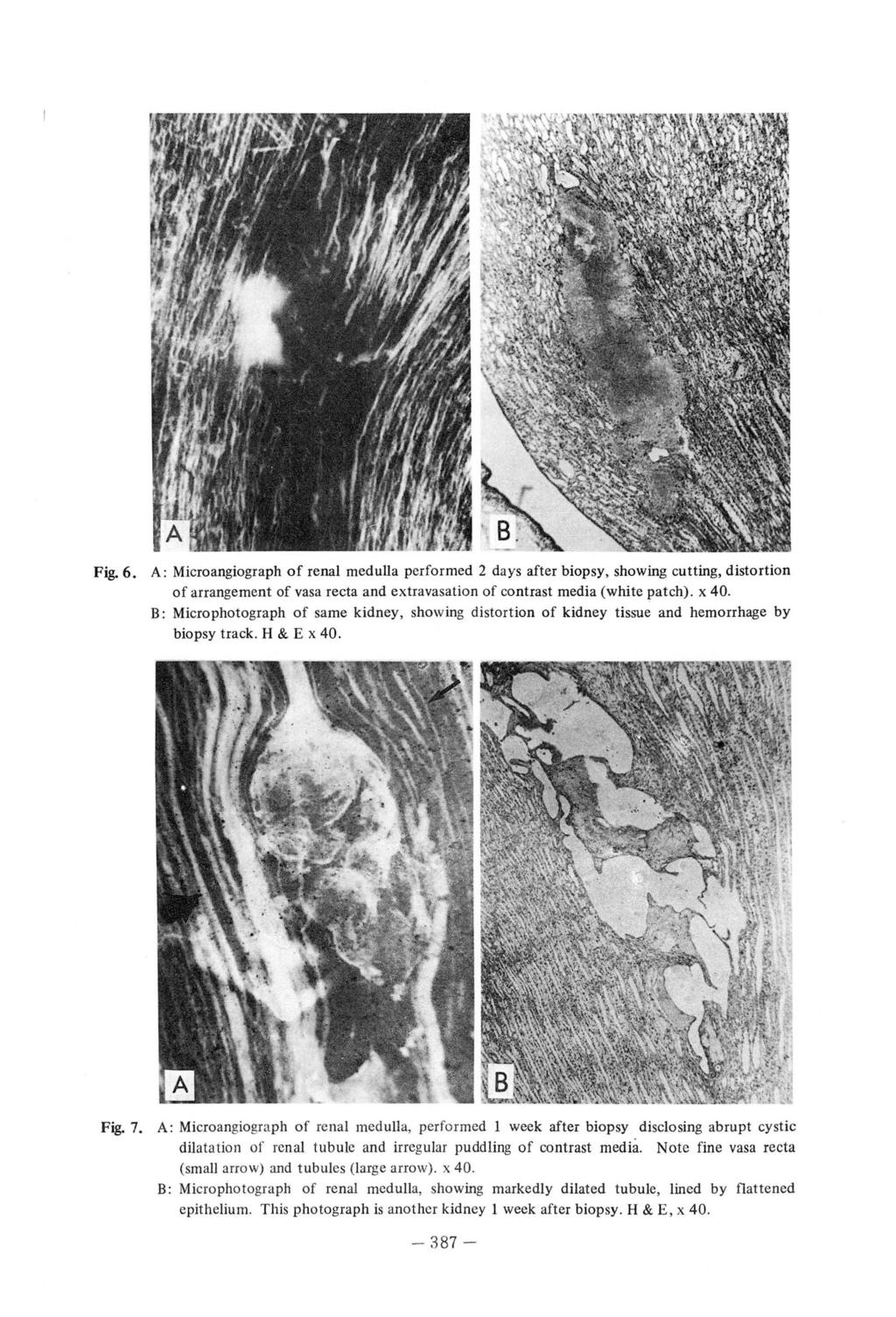 Fig.6. A: Microangiograph of renal medulla performed 2 days after biopsy, showing cutting, distortion of arrangement of vasa recta and extravasalion of contrast media (white patch). x 40.