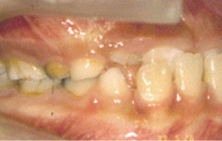 대한소아치과학회지 35(4) 2008 A B C Fig. 5. Intra-oral photographs. A. pretreatment. B. 5 months after FR Ⅲ treatment. C. postretention (5 years after treatment).