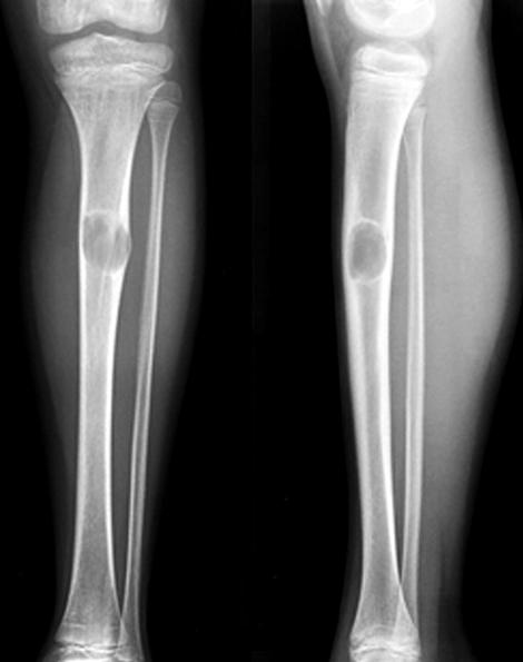 male patient show an osteolytic