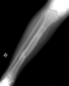 bone graft at  (F) Radiographs
