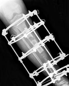 healed bone lesion. Fig. 2.