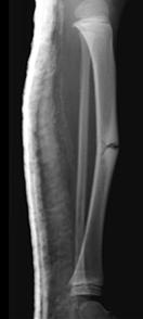fracture due to fibrous dysplasia