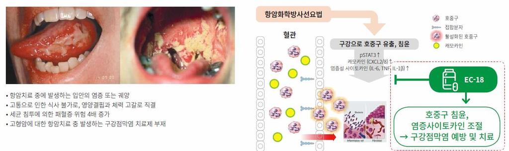 < 그림 4> 구강점막염개요및 EC-18 작용기전 자료 : 엔지켐생명과학, 하이투자증권 < 표 2> 미국 FDA 인허가전략 구분 혁신신약 (Breakthrough Therapy) 신속심사 (Fast track) 희귀질환치료제 (Orphan drug) 관련법령 Section 506(a) of the FD&C act Section 506(a) of the