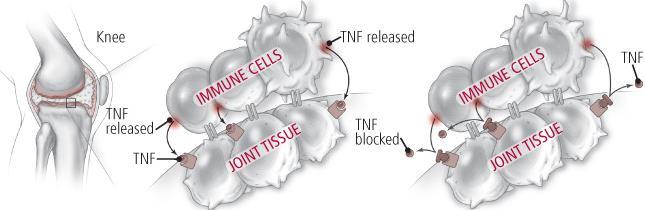 TNF-α 저해제 : 엔브렐, 레미케이드, 휴미라우리몸에서는바이러스가침입하면면역세포가이에맞서싸우는과정에서염증반응 (Inflammatory Response) 이일어나게된다. 종양괴사인자알파 (Tumor necrosis factoralpha, TNF-α) 는면역세포가분비하는단백질의일종인시토카인의한종류로서, 이러한염증반응을조절하는역할을한다.