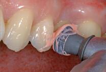 낮은마모도의페이스트인 RDA (Relative Dentin Abrasion) 7은치면세척시술자의마음을편안하게해줍니다.