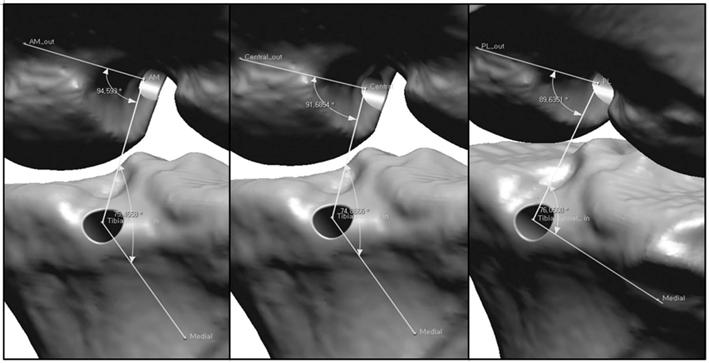The femoral and tibial GBA was calculated at the aperture of the femoral and tibial tunnel at different knee flexion angles using Rapidform program, which was also used for simulation of flexion of