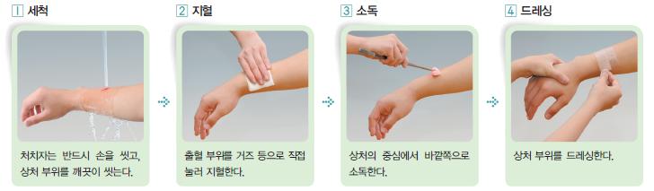 병원으로가야하는화상 - 화약약품이나전기화상, 흡입화상 -