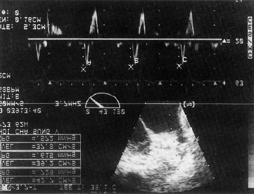 Fig. 2. Measurement of maximal forward and backward flow velocity of left atrial appendage in sinus rhythm. 통계분석 결 정상좌심방이의용적및혈류속도 과 Fig. 3.