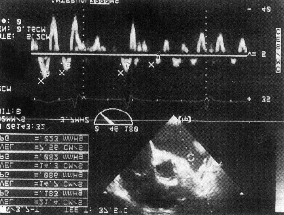 An example of left atrial appendage flow recording in patients with atrial fibrillation and preserved left atrial appendage function.