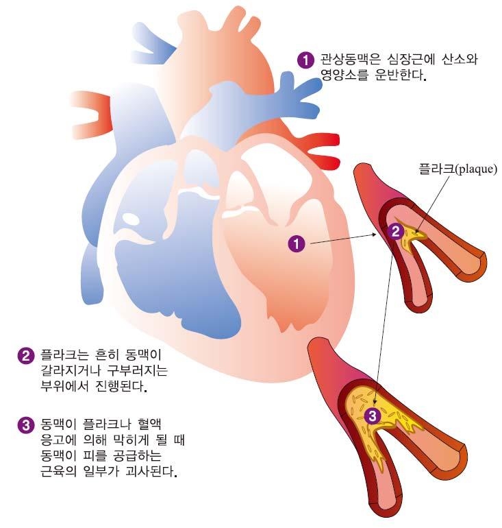 5-3 동맥경화 (Arteriosclerosis) 1.