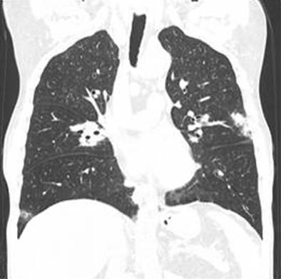 - Jong Gyu Song, et al. Limited Wegener s granulomatosis - Figure 2.