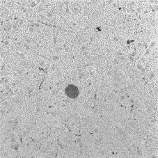 dysplasia), (5) 사마귀모양이형성증 (verrucous dysplasia), (6) 이소성신경교 -신경세포(glioneuronal heterotopia), (7) 연막하과립성신경세포의잔존 (persistent subpial granule cell layer), (8) 국소대뇌피질이형성증 (focal cortical dysplasia)