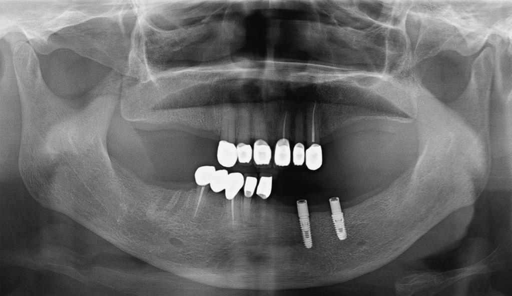 Hyo-Gyoung Yi et al. Fig. 10. Post-treatment panoramic radiograph.
