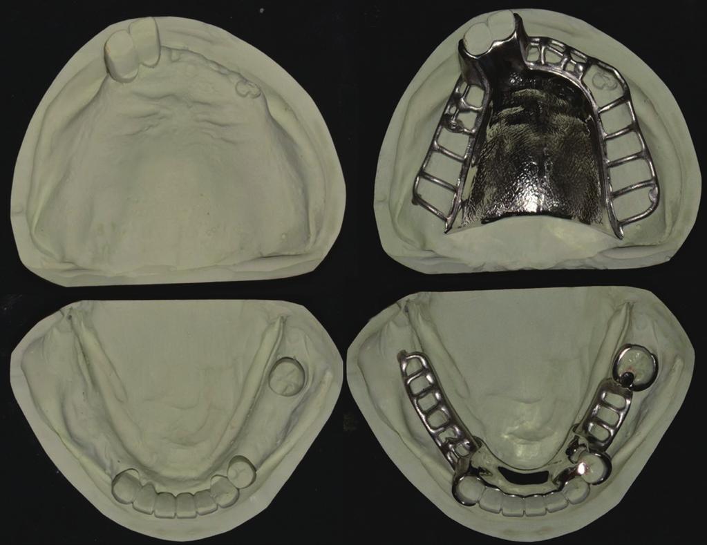 Maxillary removable partial overdenture within Locator Root ttachment in a retained root: a case report Fig. 6. Master cast and framework.