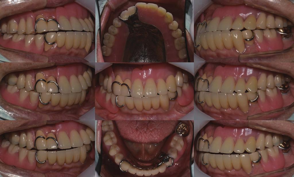 efinitive restoration (removable partial denture).