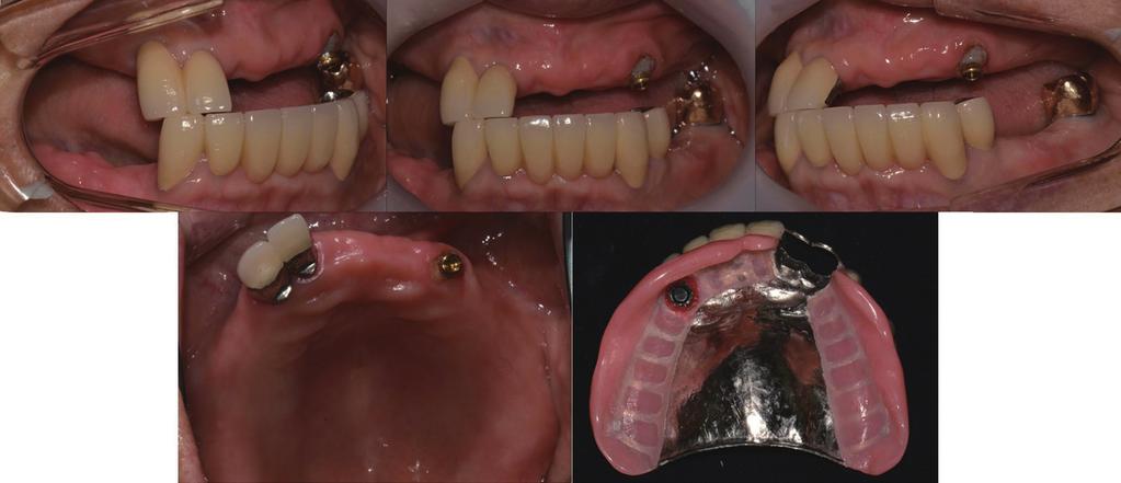 Shin JH Fig. 8. Locator Root ttachment application. () Lateral view (right side), () Frontal view, () Lateral view (left side), () Occlusal view of maxilla, () overdenture inner surface.
