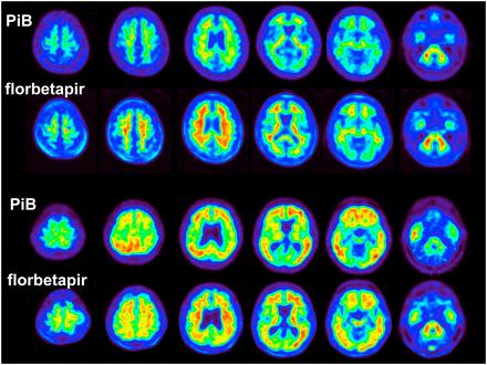Styrylpyridine [ 18 F]Florbetapir (Lilly) Stilbene