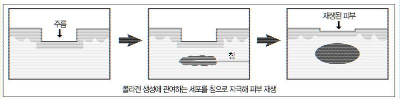 대한한방비만학회지제 7 권제 1 호 Fig. 13. Stimulate Dermis with Acupuncture 3. 시술효과오행침법시스템중의수침시스템은수술이나, 이물질이나, 마취주사나, 화학적자극없이침자극만을주로한피부진피층재생으로주름제거가가능하다.