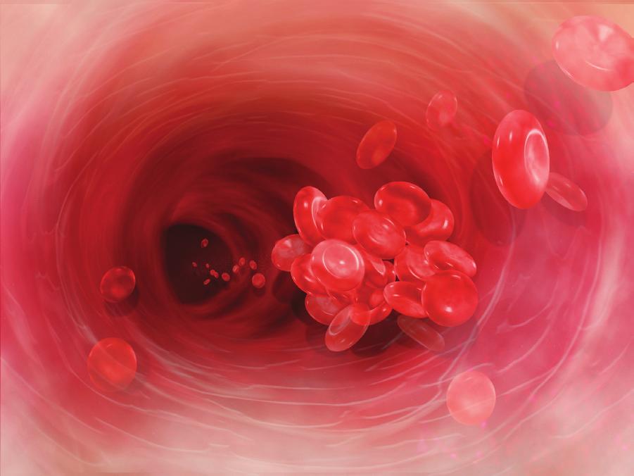 혈전증: 응혈 혈액 속의 응고 세포(혈소판이라고 함) 는 서로 들러붙습니다. 이 세포들은 병을 틀어 막는 코르크 마개와 같이 손상된 혈관을 차 단하는 역할을 합니다. 그러나 혈소판들은 반흔 조직에도 들러붙습니다. 각 바늘은 조 그만 흉터를 형성합니다. 혈액 접근로를 통 과하는 혈류가 너무 느리면, 이 조그만 흉 터들이 응혈로 이어질 수 있습니다.