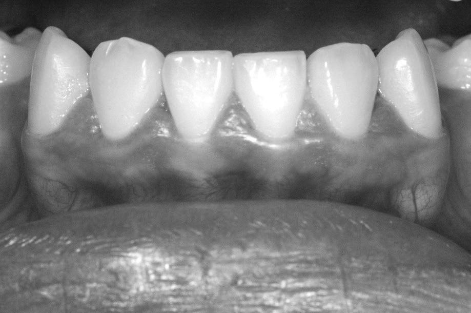 이때 치근면에 레이저가 과도하게 조사되어 치아에 손상을 주지 않도록 매우 세심한 주의가 필요하며, 치주낭 내에 존재하는 pathologic factor를 제거하기 위한 치주처치가 필요하다. Figure 3.