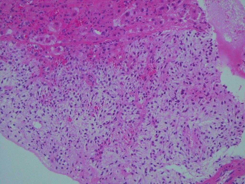 A Case of Gastrointestinal Stromal Tumor with Recurrent Hypoglycemia 127 A B C D Fig. 2. A. Pathologic finding of liver mass is composed of spindle-shaped tumor cells (H&E stain, 100).