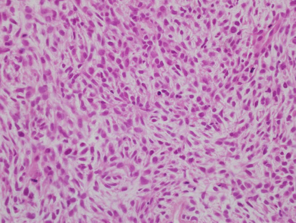 CD34 immunohistochemical stain was positive. Table 1.