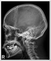 환자의위치는바로누운상태에서두개골의안와이공선이검출기에수직이되도록하고중심엑스선은비근점에수직입사하는촬영이다. 두개골이좌우대칭이되어야하며두개골표면의피부가약하게영상화되어야하며부비동과안와가적정하게농도가형성되어야한다. 2.6.