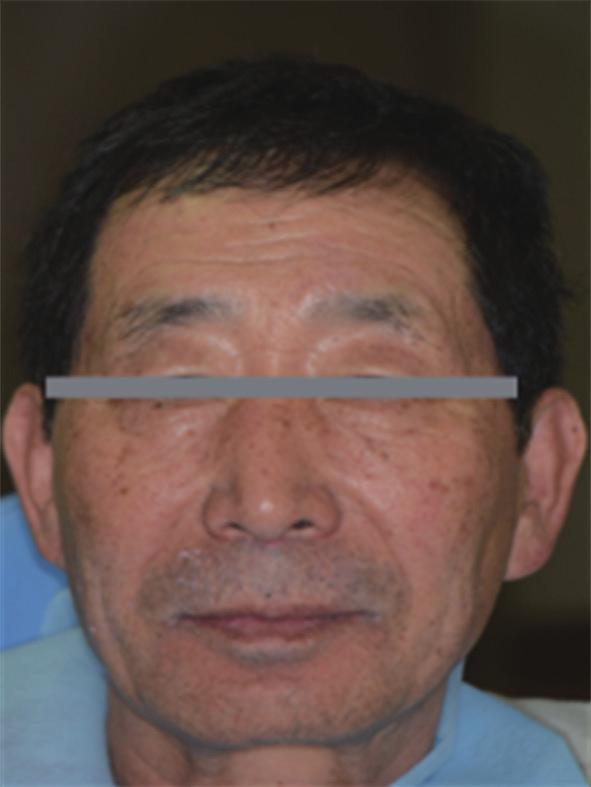 Facial photographs before treatment. () Frontal view, () Lateral view.