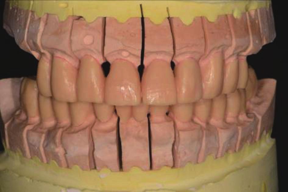 Fig. 9. Full contour wax-up & cut back & coping try in.
