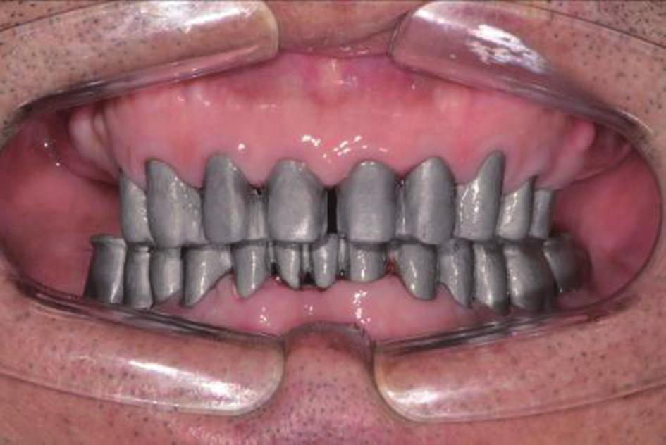 Maxillary removable partial denture fabrication.