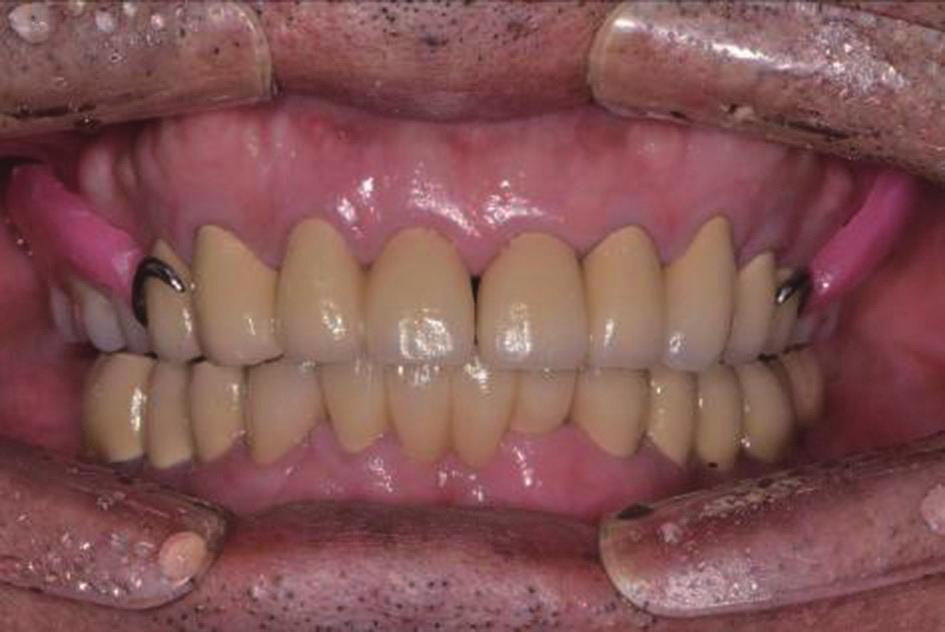 마운팅한 후 치아배열(Endura teeth, Premiere dental, Kuala Lumpur,Malaysia)을 시행하고 의치상용 레진을