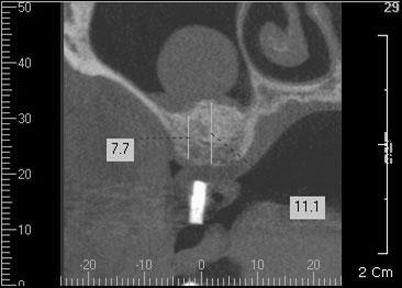 ORIGINAL ARTICLE typically observed in dental cysts was not visible (Fig. 1). Using panoramic radiographs and computed tomography images, radiopaque lesions with a size ranging from 18.6 mm x 15.