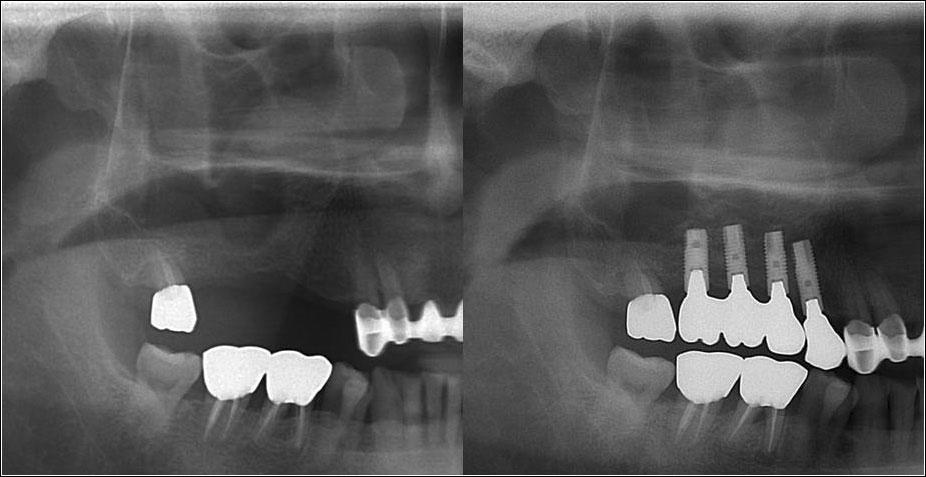 ORIGINAL ARTICLE from the perforation of the maxillary membrane were observed in only one case; therefore, treatments applying absorbable membranes were performed.