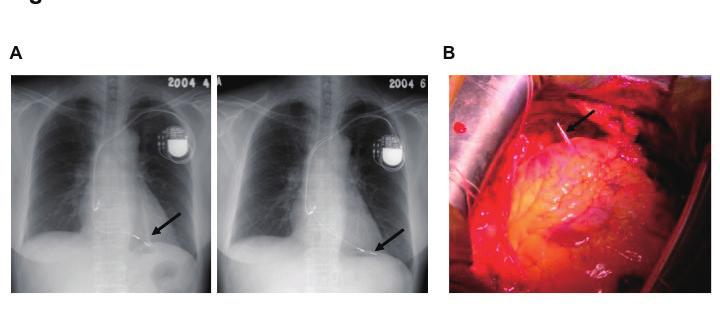 A B Main Topic Reviews Figure 1. Pacemaker lead perforation.