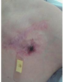 ECG & EP Cases Figure 1. Erythema around the pacemaker pocket site. Figure 2. Chest radiograph prior to pacemaker lead extraction.