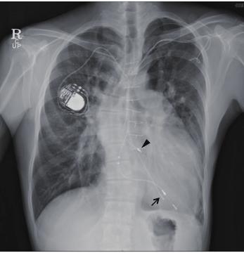 The ventricular lead was been extracting by traction and counter traction force via a locking stylet and a telescopic dilator sheath. pacemaker.