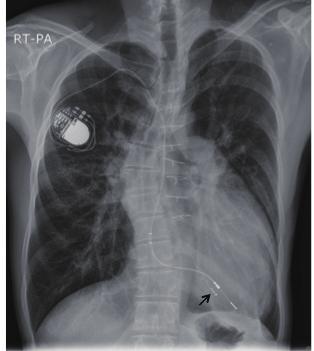 Although blood cultures were negative, clinical and laboratory findings were consistent with pacemaker pocket infection.